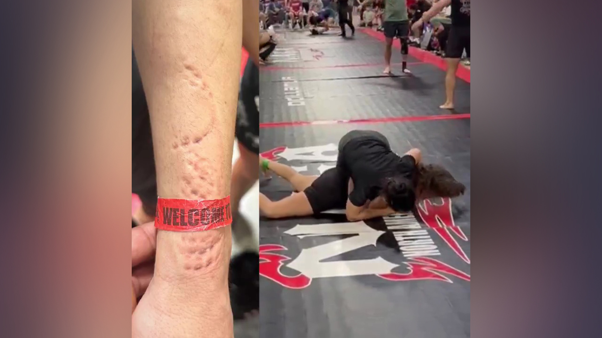 胳膊上都是牙印！美国女子柔术比赛，选手缠斗中竟恶意咬人，被取消参赛资格