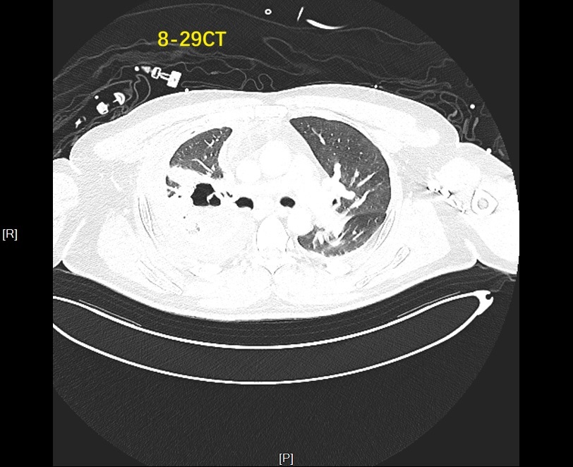 图为患者支气管胸膜瘘发生严重感染
