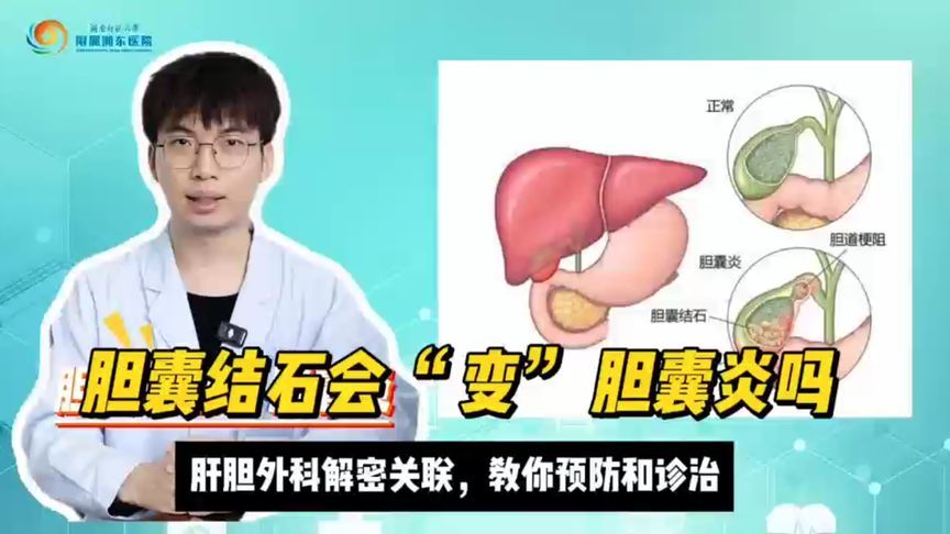 胆囊结石会“变”胆囊炎吗？你想了解的都在这