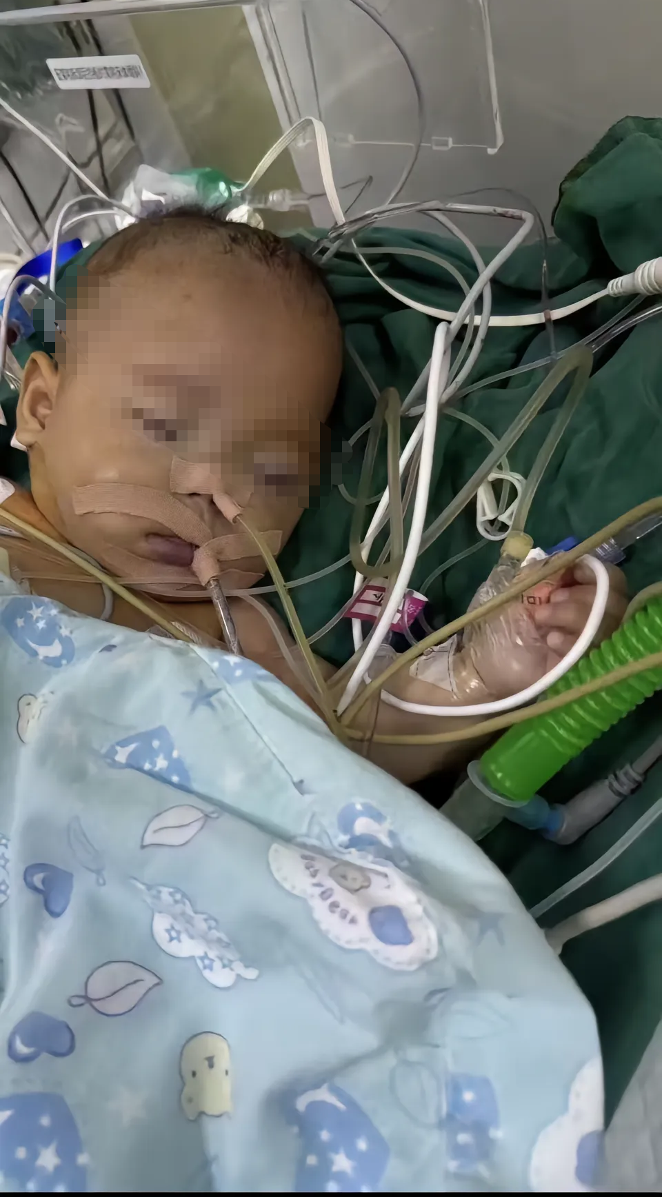 手術后的小洛熙。