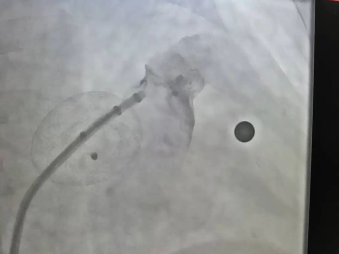 成功建立一条轨道并成功植入左心耳封堵器