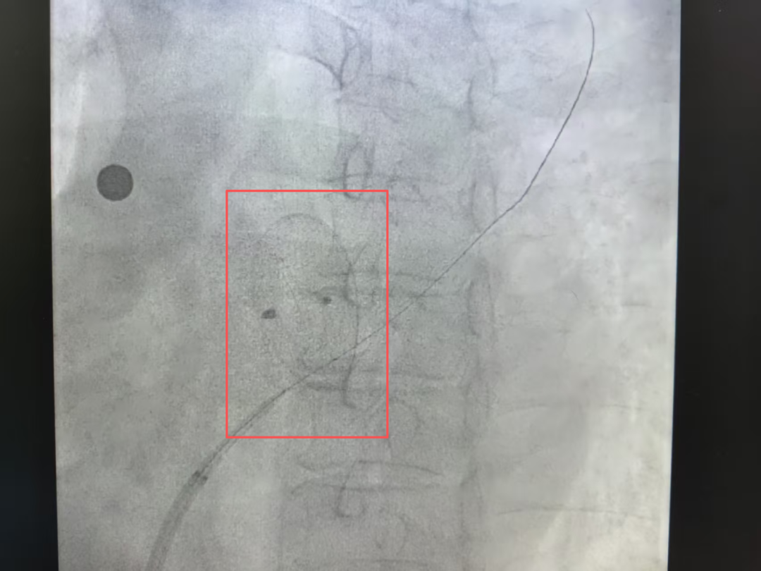 纤细的导丝成功穿透封堵器(红框处)