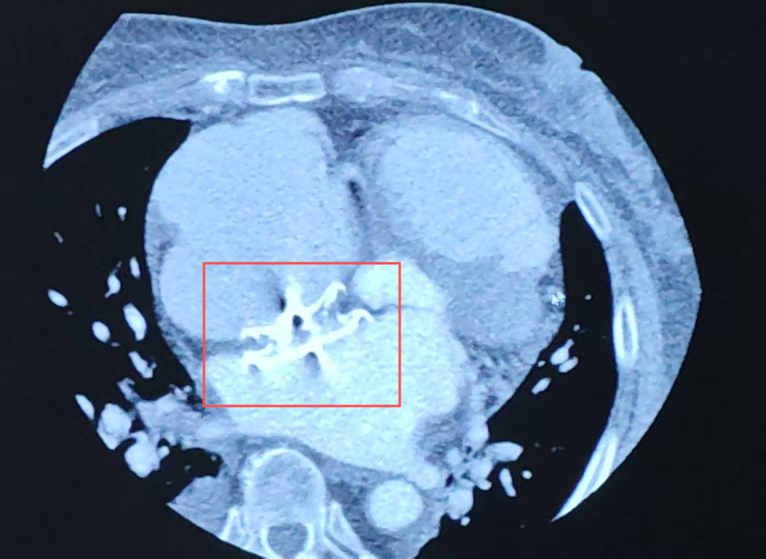 房间隔封堵器挡住了介入手术的必经之路