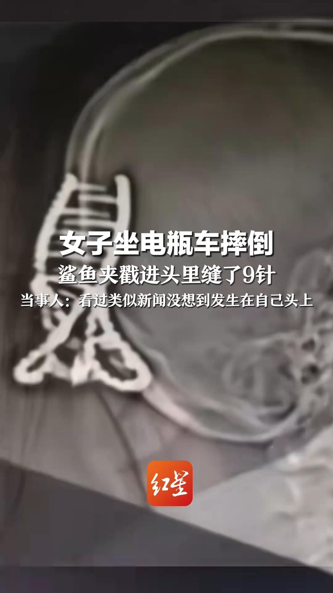 女子坐电瓶车摔倒 鲨鱼夹戳进头里缝了9针 当事人：看过类似新闻 没想到发生在自己头上