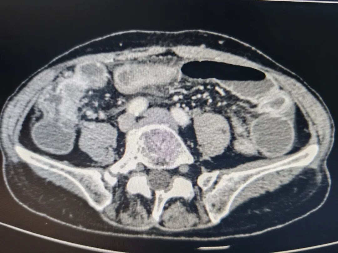 CT显示回盲部梗阻