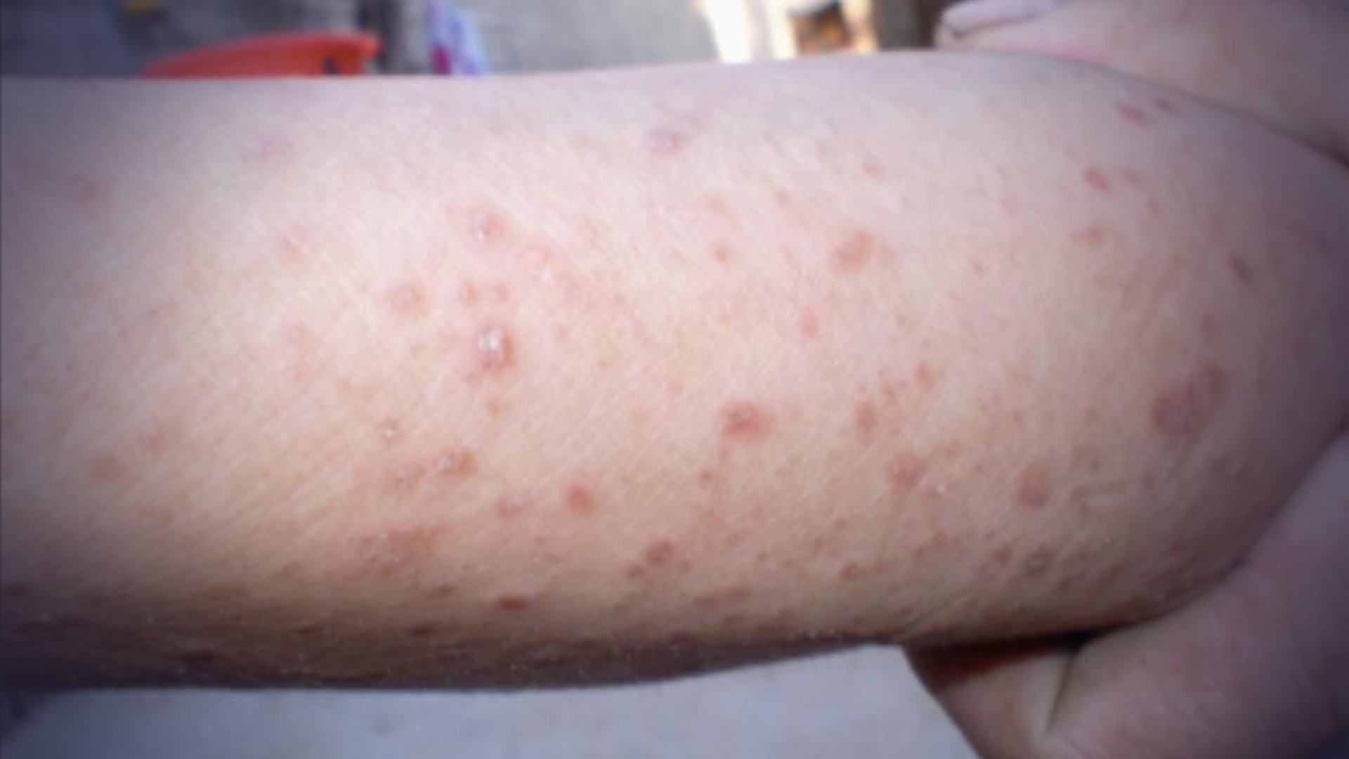 警惕！奶奶嘴对嘴喂饭，导致4岁女孩感染梅毒