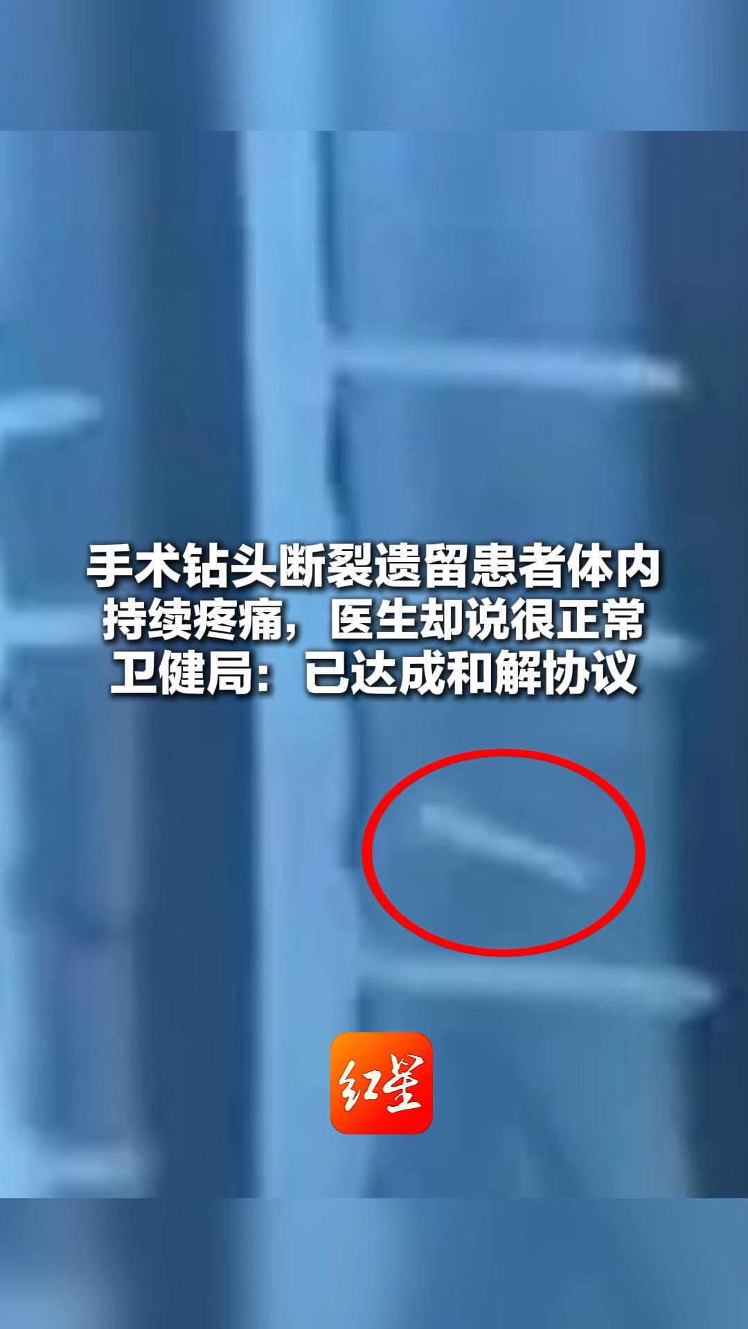 手术钻头断裂遗留患者体内 持续疼痛，医生却说很正常 卫健局：已达成和解协议 将对相关责任人严肃追责