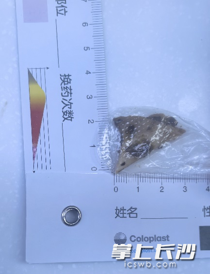 手术时从患者食管中取出的碎骨异常尖锐。通讯员供图