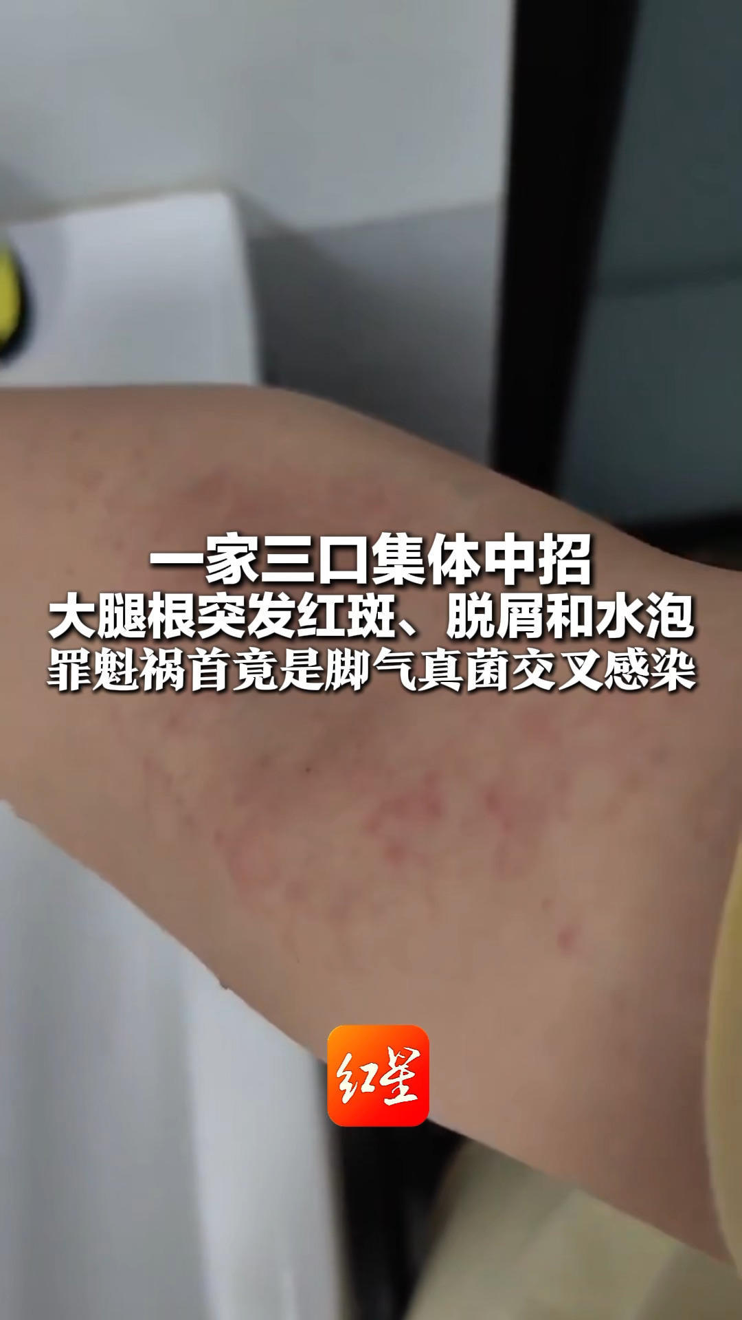 一家三口集体中招 大腿根突发红斑、脱屑和水泡 罪魁祸首竟是脚气真菌交叉感染 医生：大人小孩衣物别混洗