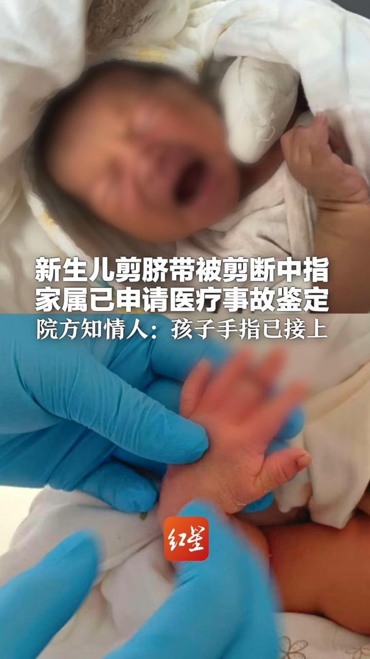 新生儿剪脐带被剪断中指 家属已申请医疗事故鉴定 院方知情人：孩子手指已接上  正全力配合治疗