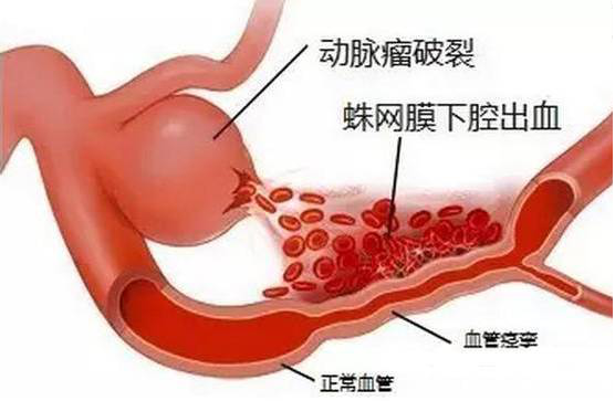 58岁杨叔“工作劳累”致头痛!没成想是病死率高达45%的……
