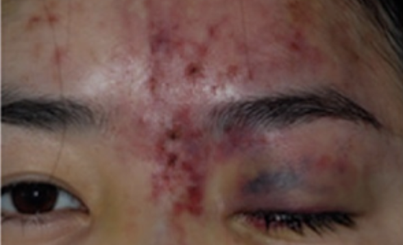 视力丧失、完全性上睑下垂及皮肤缺血