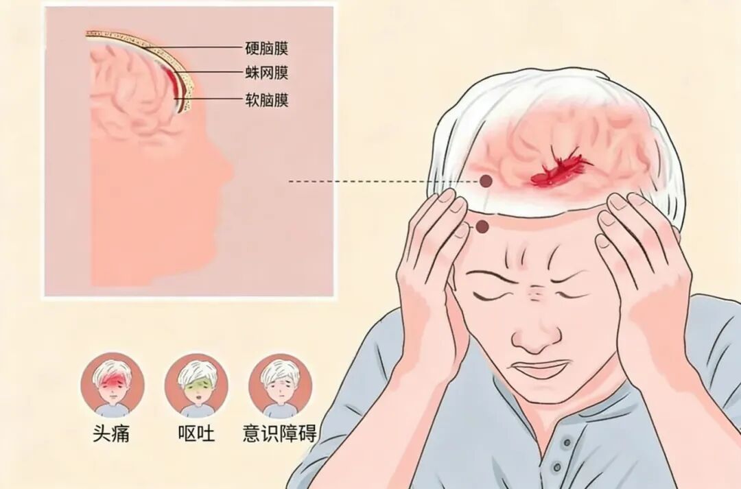 58岁杨叔“工作劳累”致头痛!没成想是病死率高达45%的……