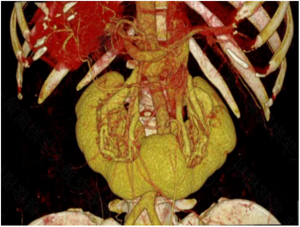 供者马蹄肾CT血管成像(CTA)