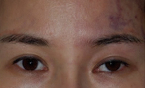 上睑下垂、斜视及皮肤缺血