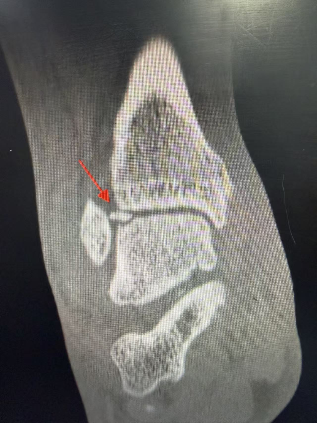 术前影像学检查 踝关节正位片