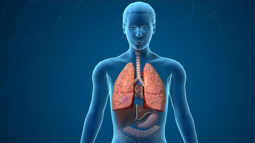 这种肺结节，竟然会自己消失？|凤凰大健康