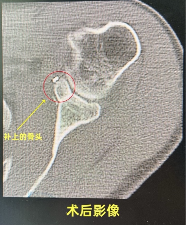 “叛逆”的肩膀VS“王牌”的医术  深圳医生两小时“驯服”法国奶爸多年旧伤