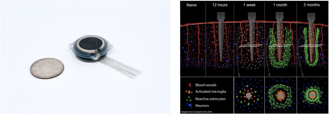 由外科手术机器人将植入物电极线（左）插入大脑，每根细线的粗细仅为人类头发的十分之一