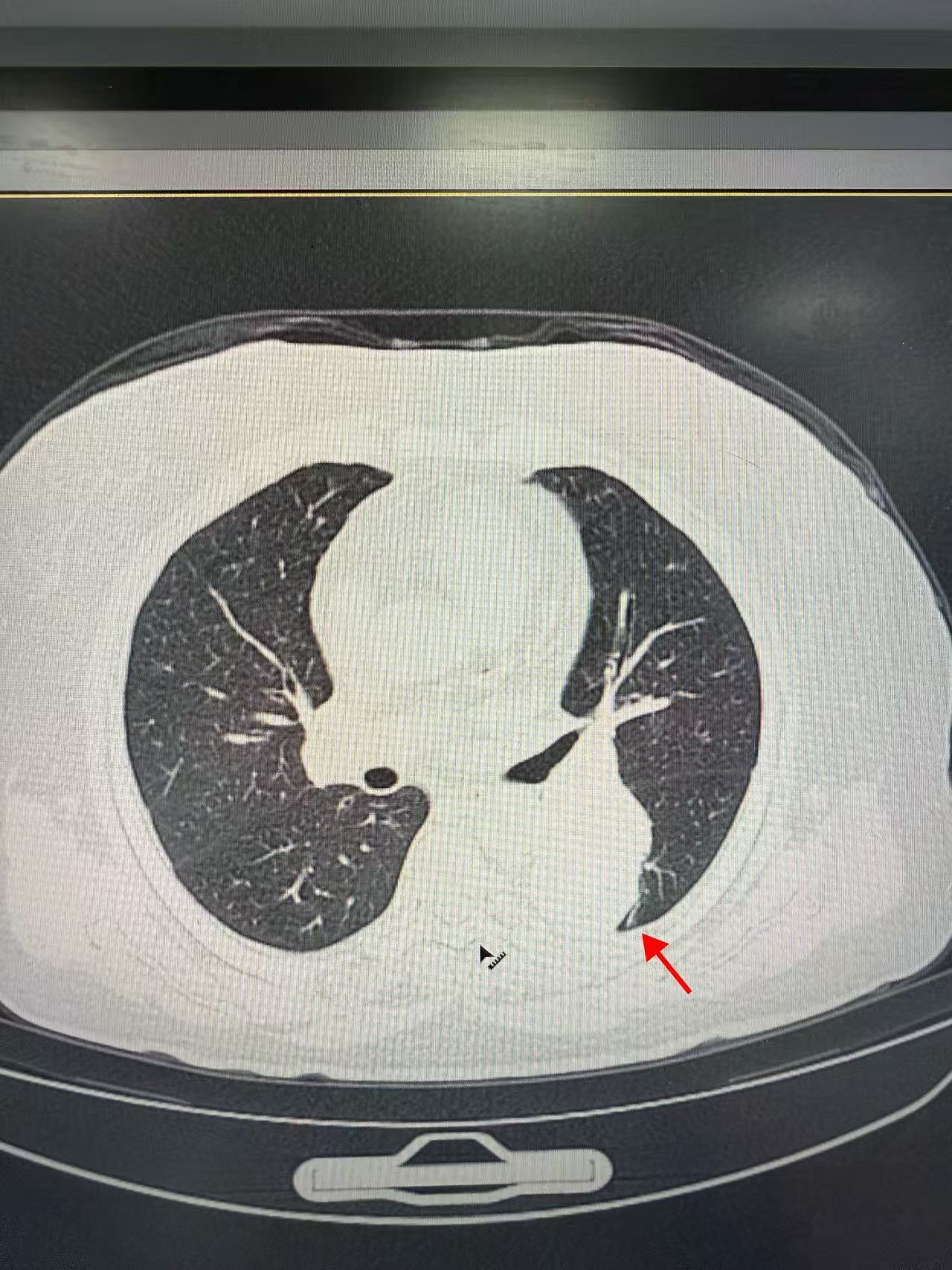 紧邻肺“大门”现6cm巨大占位性病变！北大胸外科周足力教授精准实施高难度胸腔镜下肺段切除术