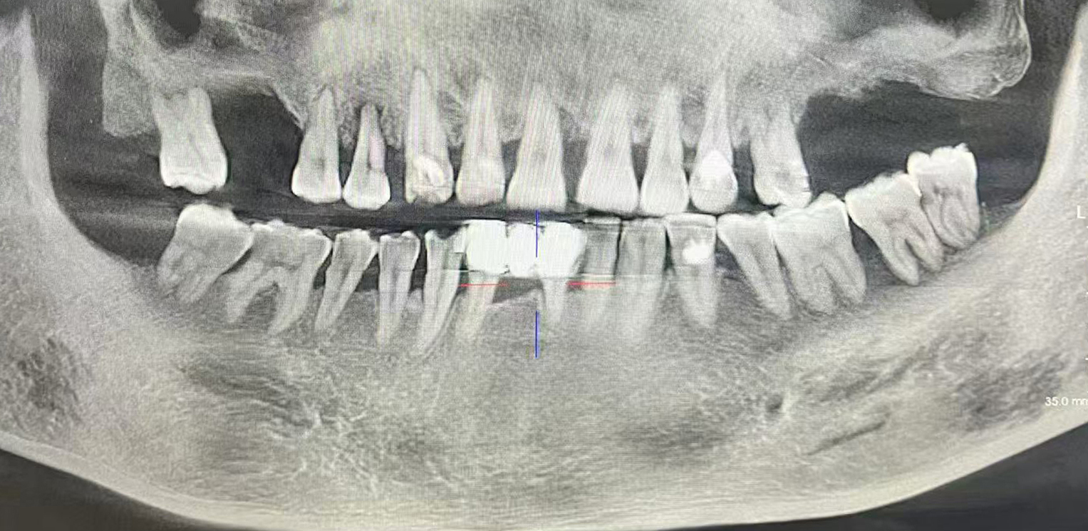 牙龈出血、红肿胀痛?别不当回事!做好这件事 让口腔“地基”更稳固