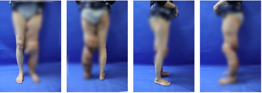 ◎ 手术后，左腿肿胀明显消退　/ 图：医院提供