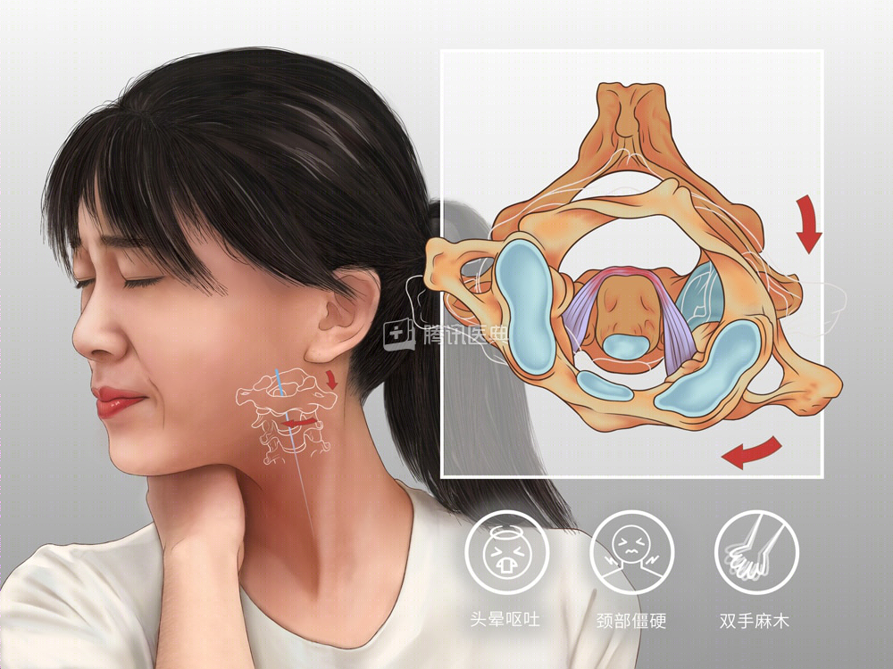 寰枢关节半脱位；图源：腾讯医典