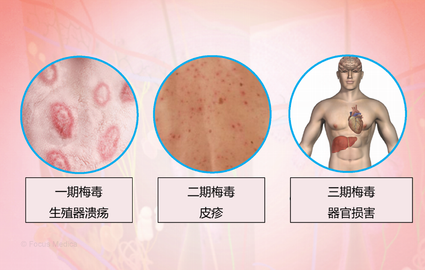 梅毒的分期和常见症状　图源：chandigarhayurvedcentre.com