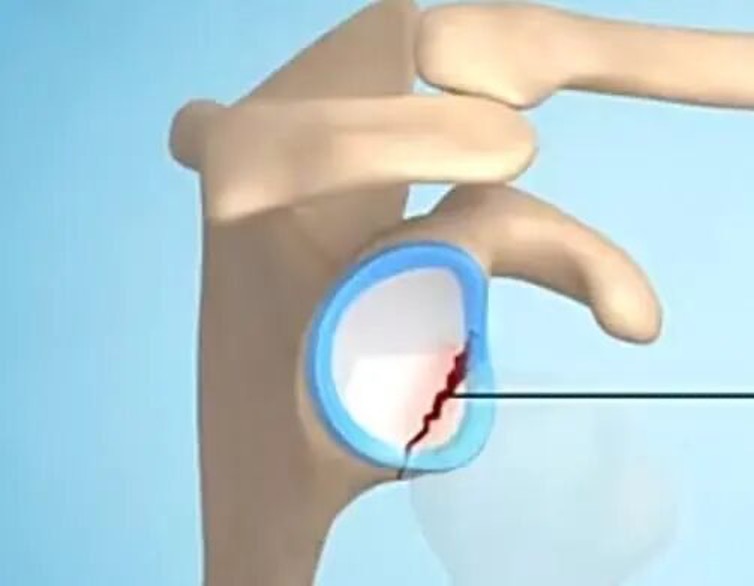 “叛逆”的肩膀VS“王牌”的医术  深圳医生两小时“驯服”法国奶爸多年旧伤