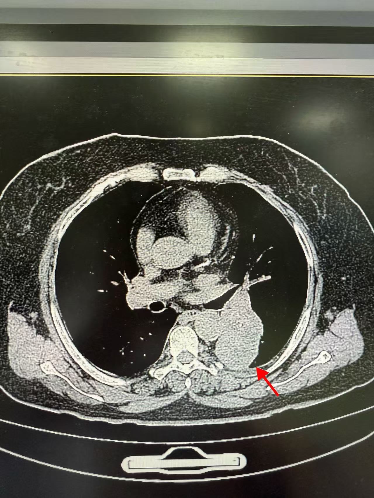紧邻肺“大门”现6cm巨大占位性病变！北大胸外科周足力教授精准实施高难度胸腔镜下肺段切除术