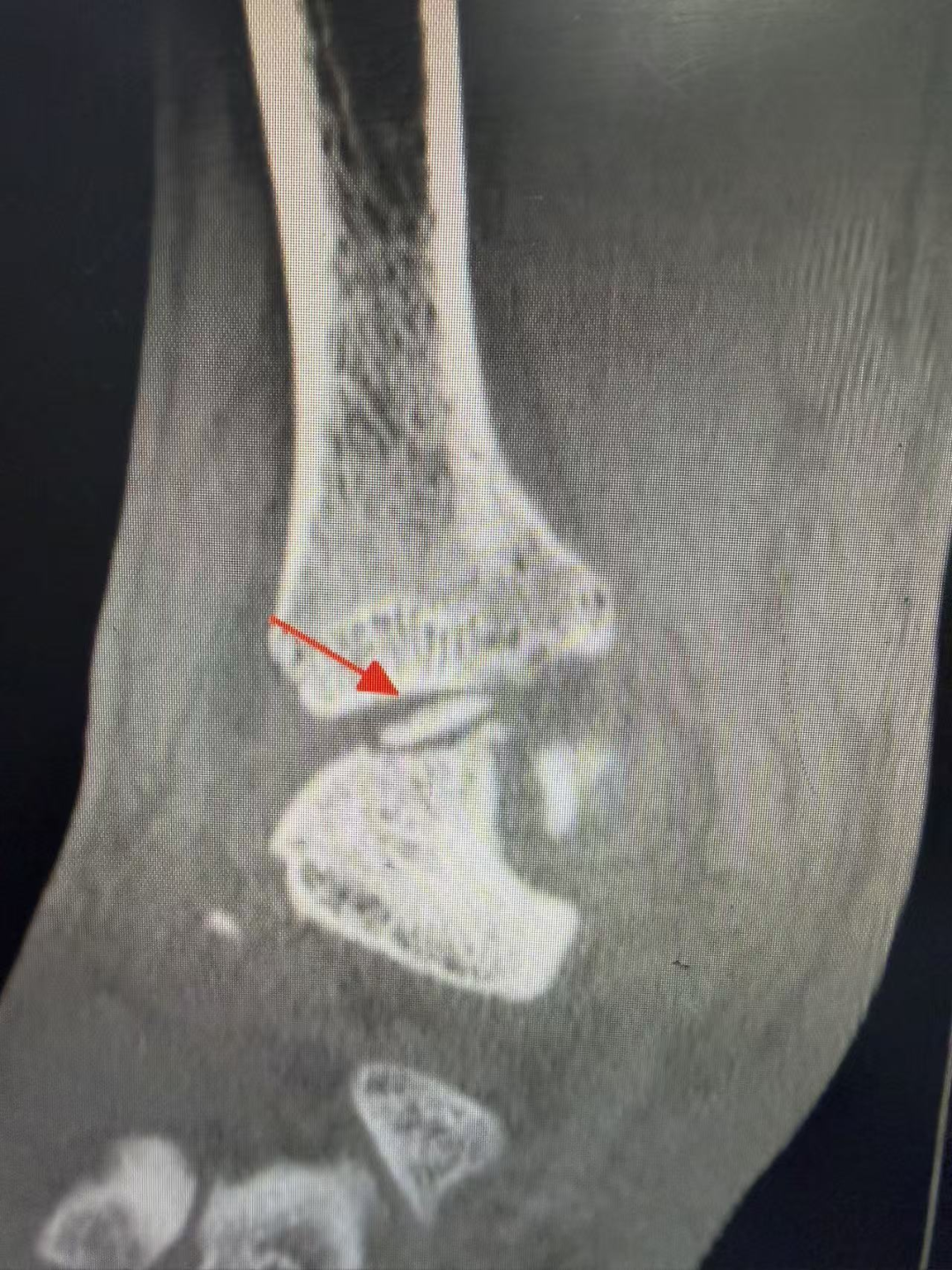 术前影像学检查 踝关节侧位片