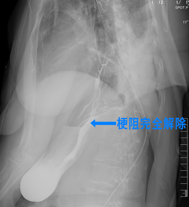 消失的饭?他明明吃了 胃里却没 一年消瘦20斤……