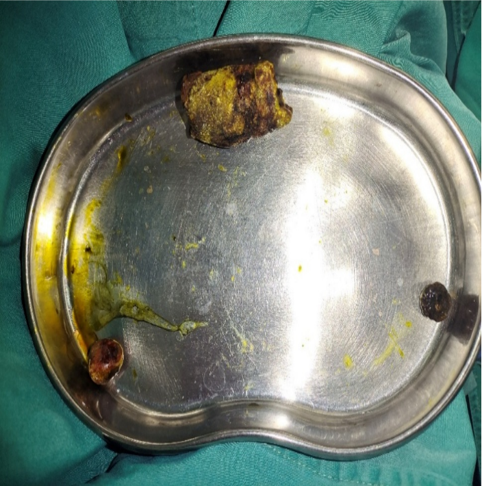 李阿姨小肠内取出的三枚结石