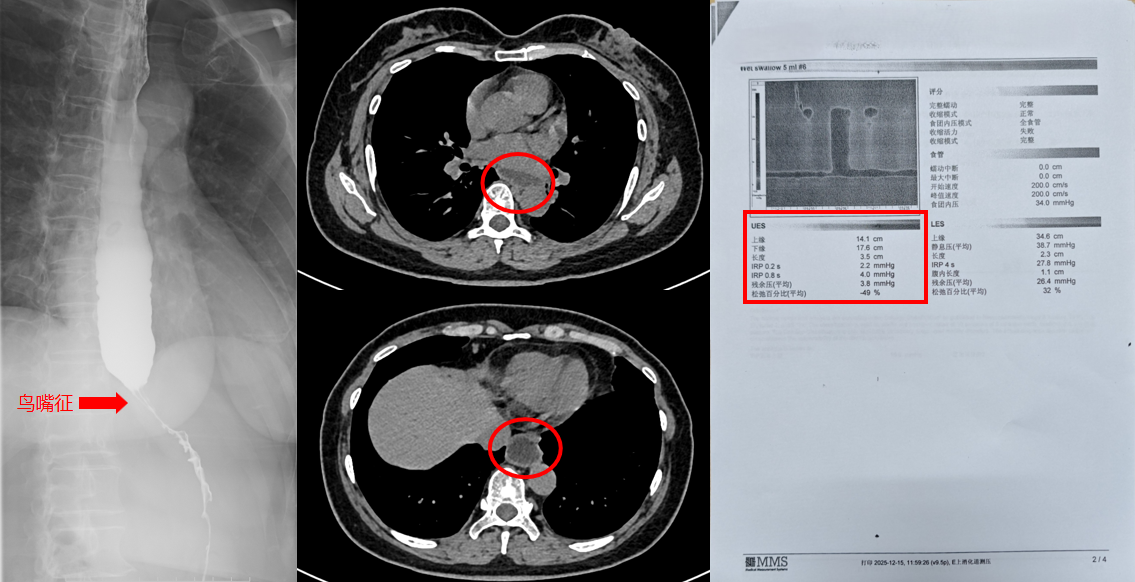 消失的饭?他明明吃了 胃里却没 一年消瘦20斤……