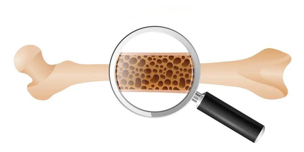 骨质疏松的12个高危因素，你中了几个？