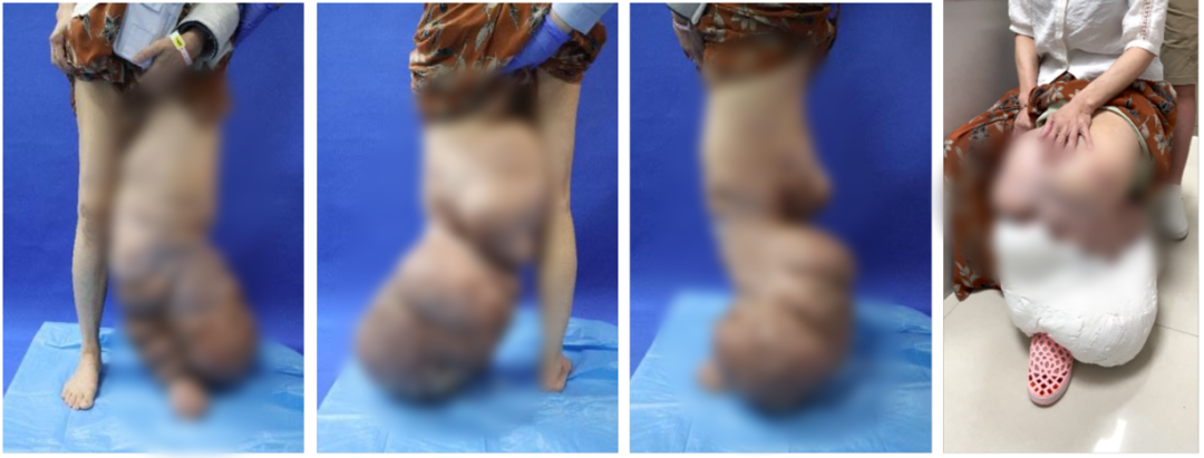 ◎ 刘女士左腿淋巴水肿　/ 图：医院提供