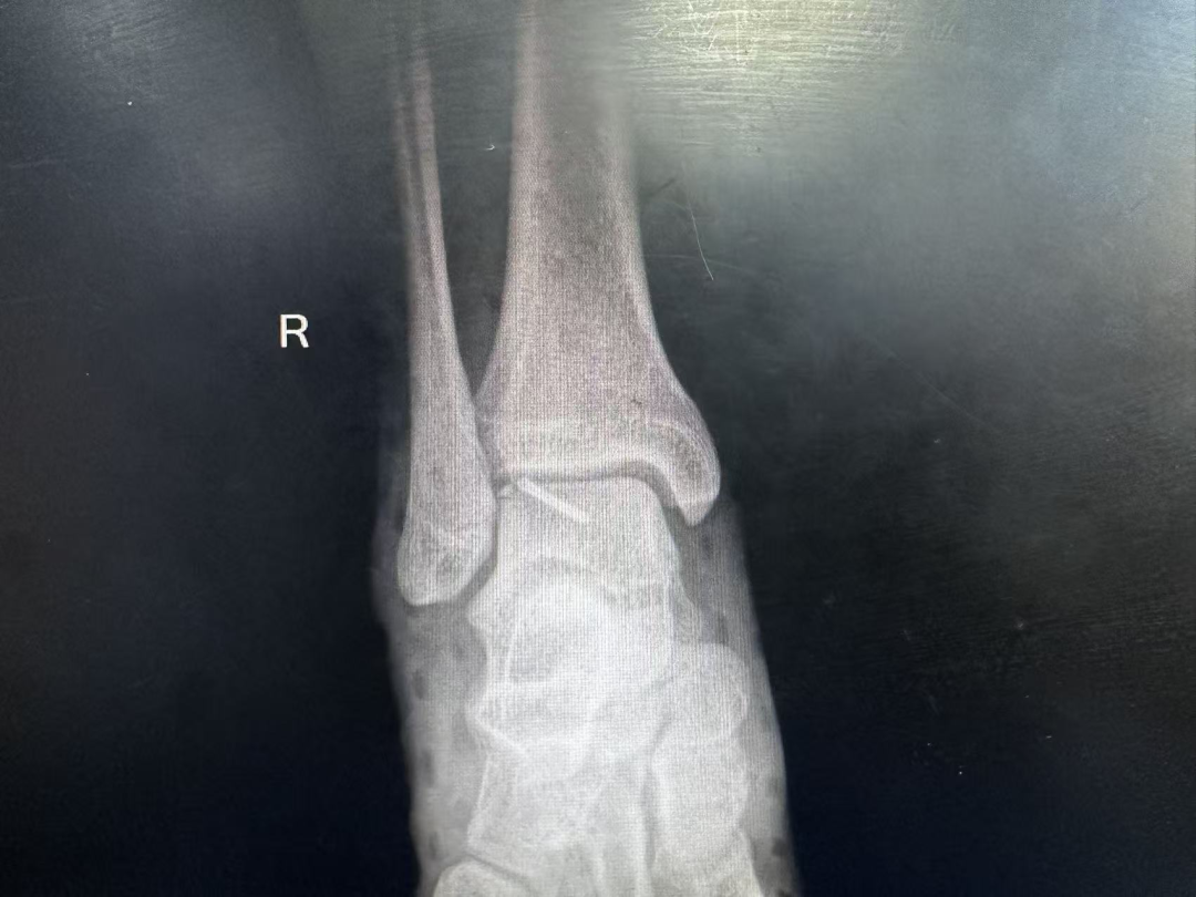 术后影像学检查 踝关节正位片
