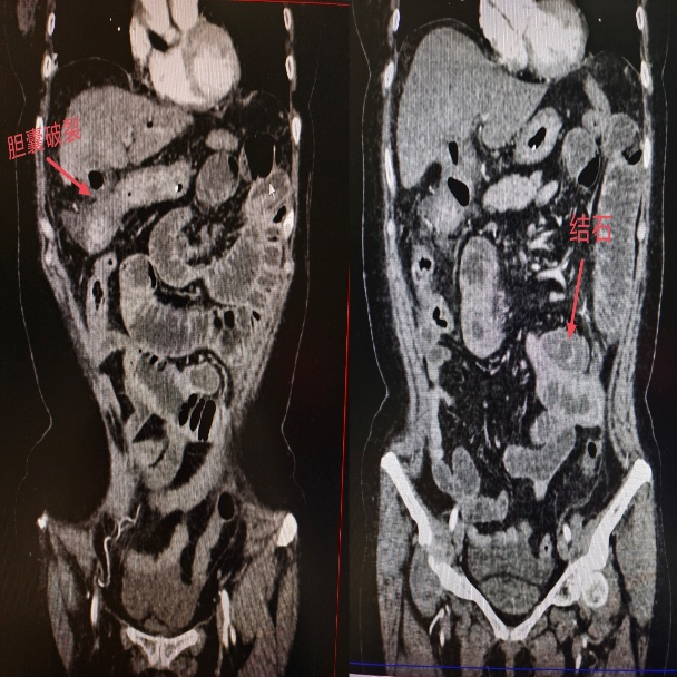 胆囊结石忍了又忍 这次撑破胆囊掉进小肠卡死
