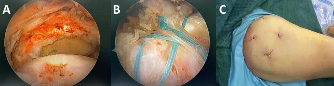 肩关节镜下肩袖修补术 A：镜下见肩袖巨大撕裂，肌腱回缩，肱骨头完裸露。B：双排缝合桥技术修补肩袖巨大撕裂，修补后肌腱完全覆盖肱骨头。C：术后伤口。