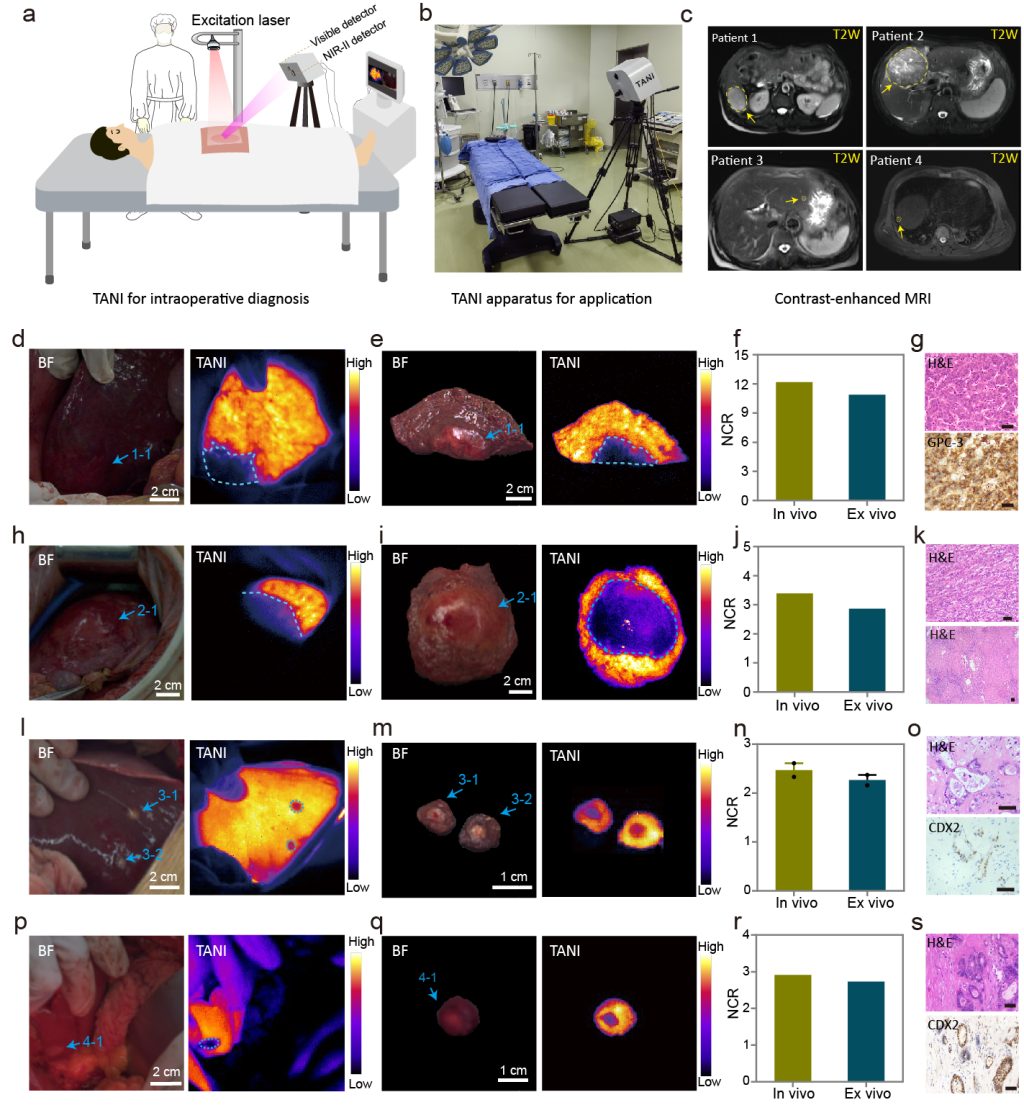 TANI技术于患者体内实时可视化肝恶性肿瘤的流程、装置与效果图。