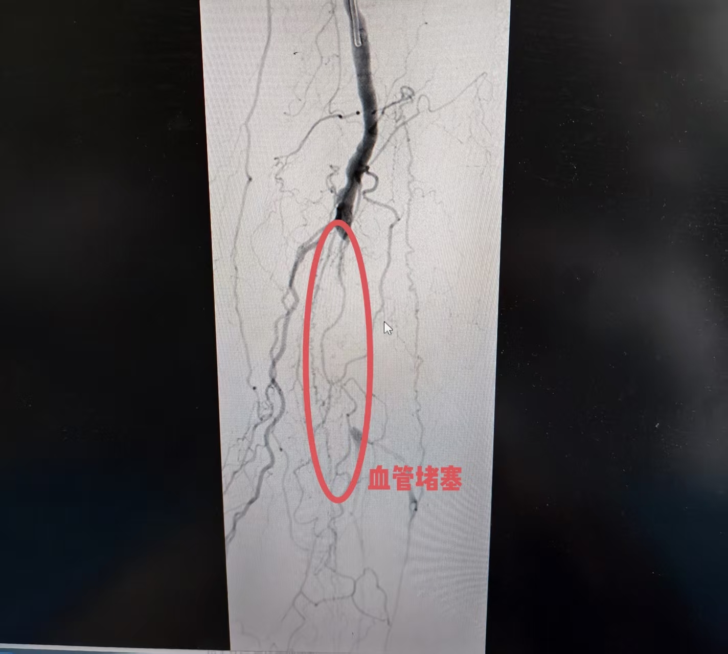 血栓堵塞动脉险酿大祸!血管外科“国家队”微创手术为患者成功保肢