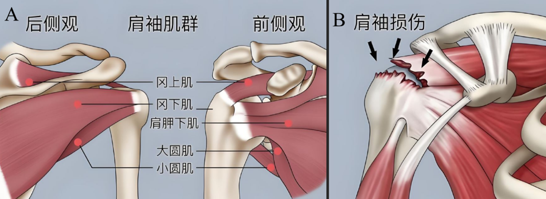 肩袖及肩袖损伤示意图 A：肩袖由肩胛下肌、冈上肌、冈下肌、小圆肌的肌腱组成，形成像“套袖”一样的结构，包裹于肩关节肱骨头前方、上方以及后方。B：肩袖损伤：冈上肌腱撕裂。