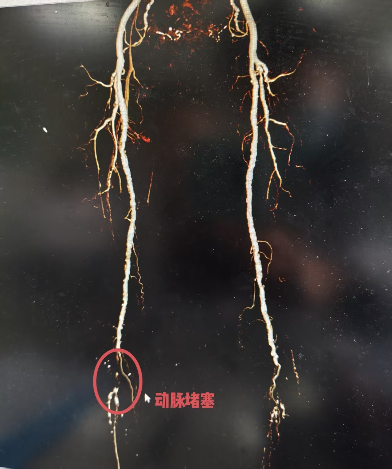 血栓堵塞动脉险酿大祸!血管外科“国家队”微创手术为患者成功保肢