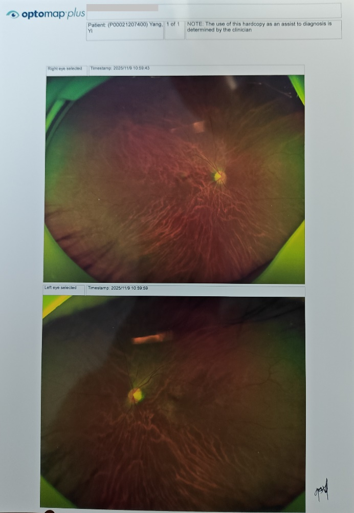 扫描激光眼底检查报告丨作者供图