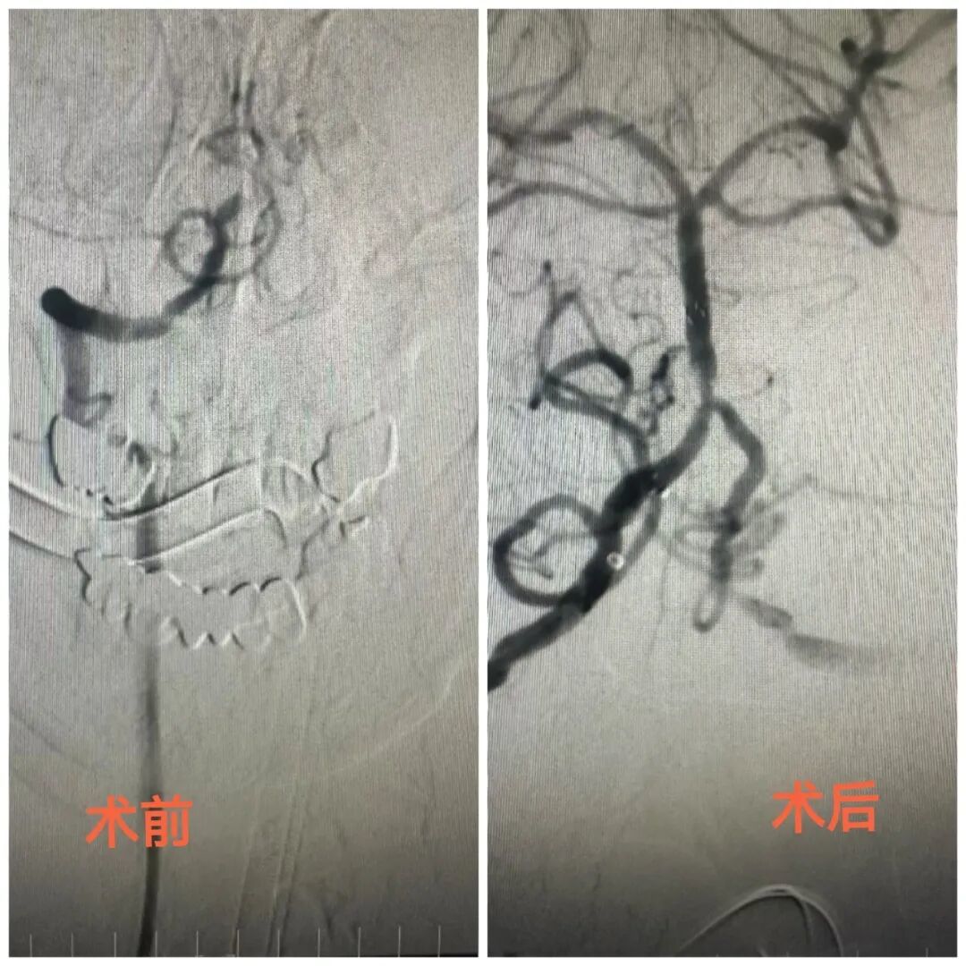 寒冬脑梗高发期!一天两例急救 医生给出关键防护建议