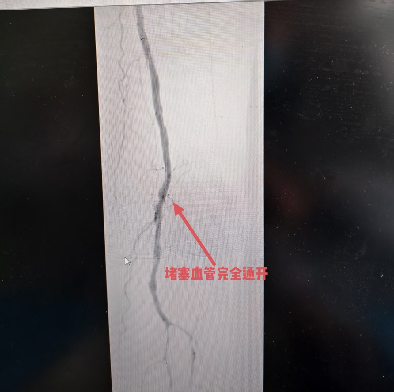 血栓堵塞动脉险酿大祸!血管外科“国家队”微创手术为患者成功保肢