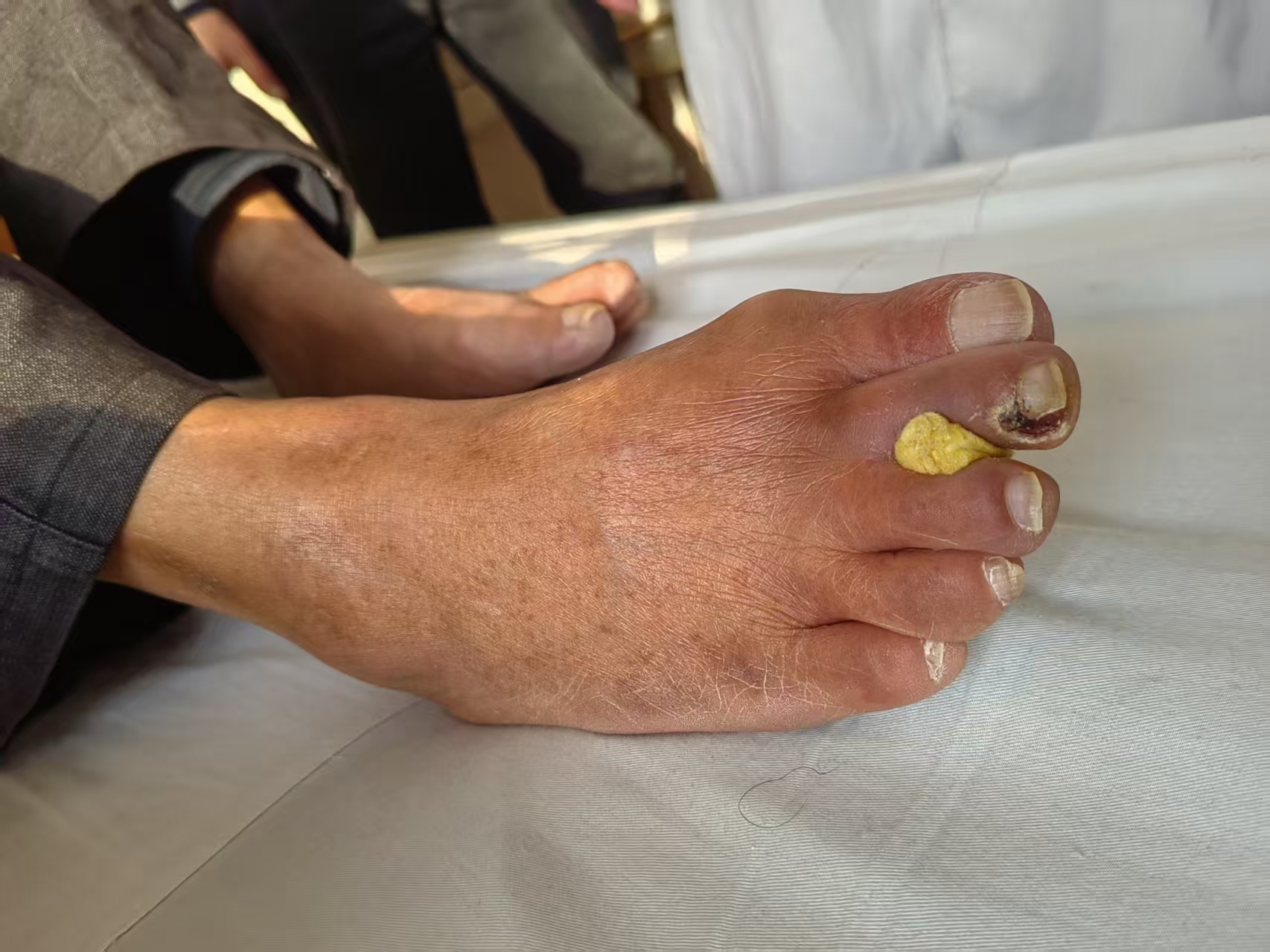 血栓堵塞动脉险酿大祸!血管外科“国家队”微创手术为患者成功保肢