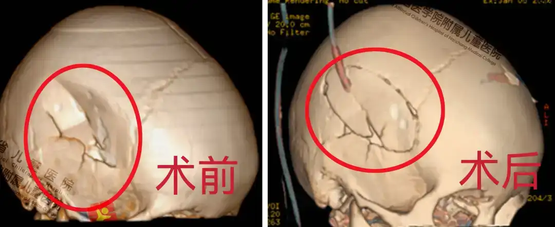 5岁男童摔伤致颅骨重创，江西省儿童医院神经外科妙手化险