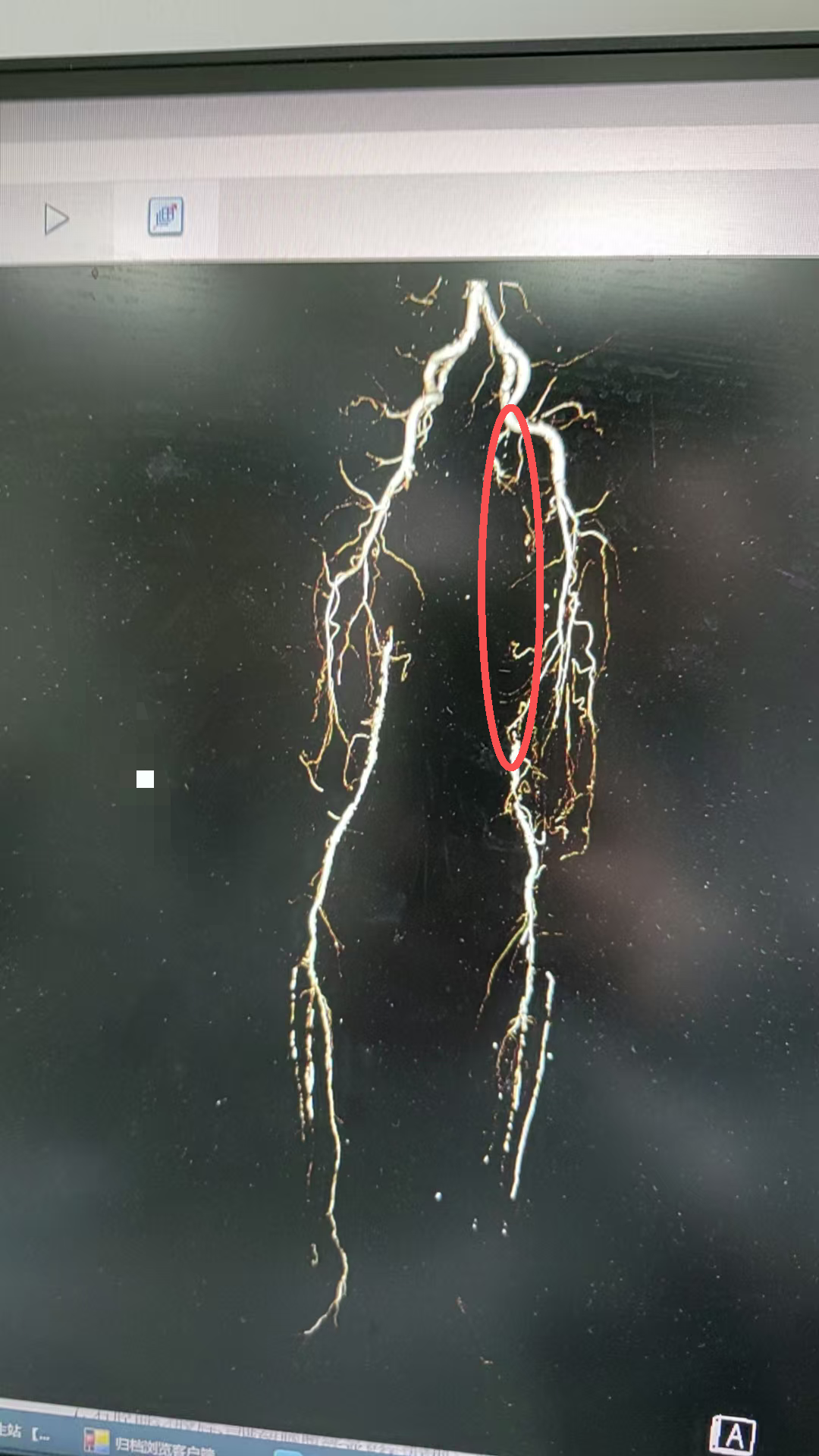 血栓堵塞动脉险酿大祸!血管外科“国家队”微创手术为患者成功保肢