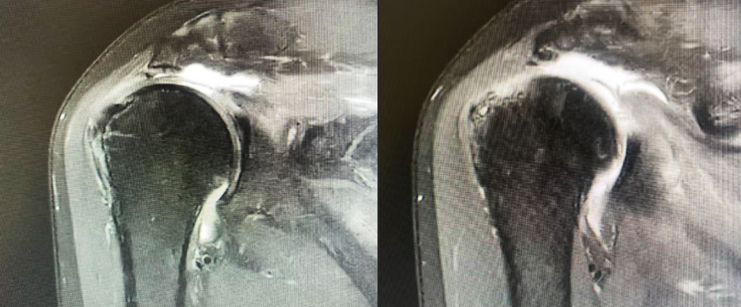MRI显示肩袖巨大撕裂，肌腱断端回缩至关节盂水平